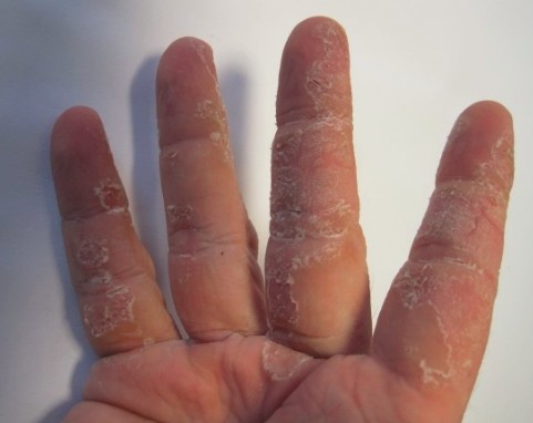 病気 手 の 皮 が むける 手のひらの皮がむける原因と対処方法。ストレスの影響もある？