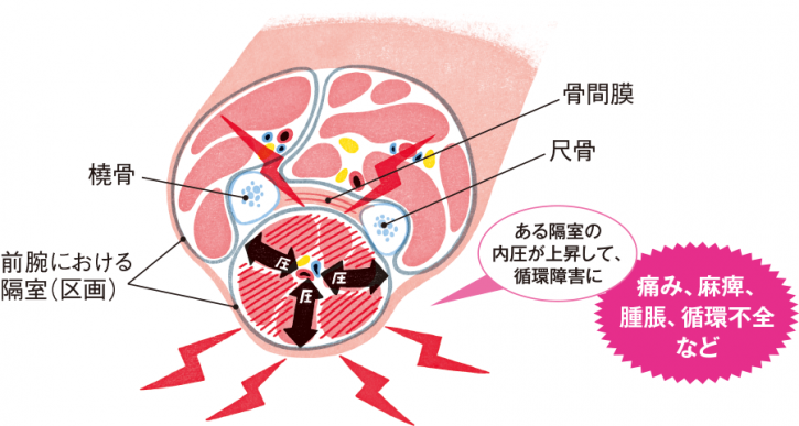 コンパートメント症候群の原因と予防方法 | トリビアーノ