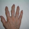 手の腫れ